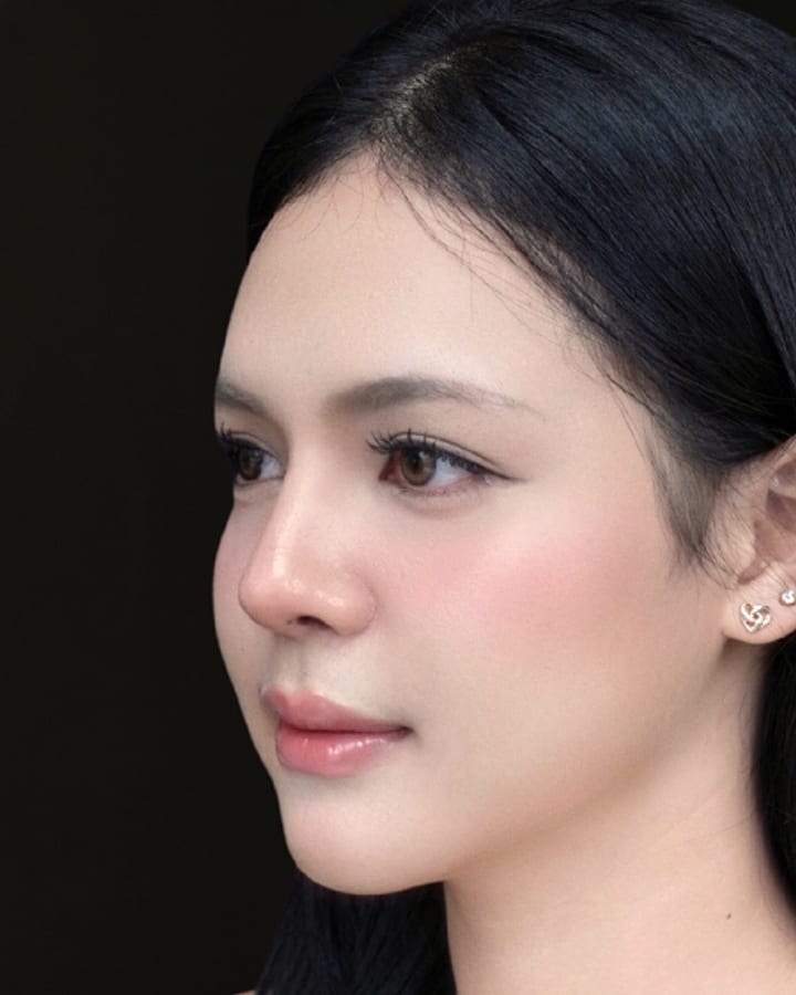 ภาพหลังทำ — เคสเสริมจมูกเทคนิค Open Rhinoplasty มุมเฉียง เปรียบเทียบก่อนทำและหลังทำ