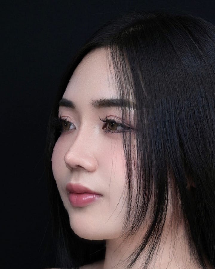 ภาพหลังทำ — เคสเสริมจมูกเทคนิค Open Rhinoplasty มุมเฉียง เปรียบเทียบก่อนทำและหลังทำ