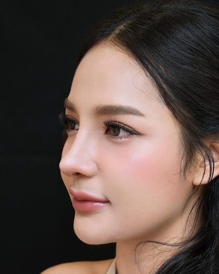 ภาพหลังทำ — เคสเสริมจมูกเทคนิค Open Rhinoplasty มุมเฉียง เปรียบเทียบก่อนทำและหลังทำระยะแรกที่ยังมีอาการบวม