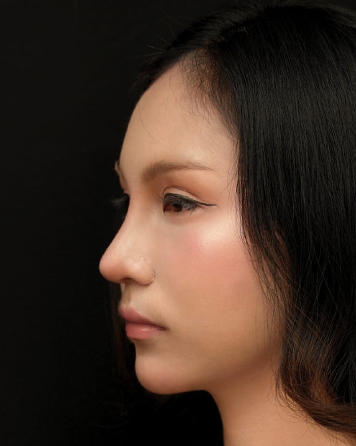 ภาพหลังทำ — เคสเสริมจมูกเทคนิค Open Rhinoplasty มุมด้านข้าง เปรียบเทียบก่อนทำและหลังทำ