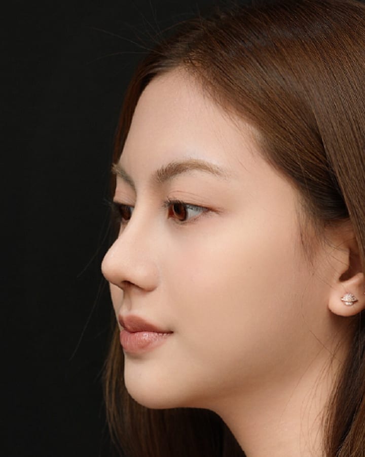 ภาพหลังทำ — เคสเสริมจมูกเทคนิค Open Rhinoplasty มุมเฉียง เปรียบเทียบก่อนทำและหลังทำ 1 เดือน