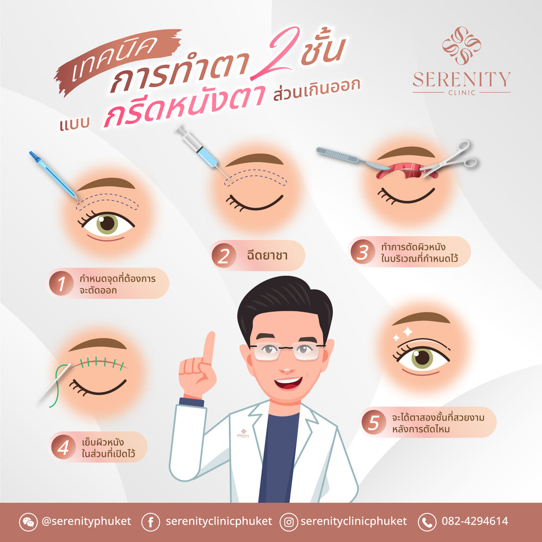 ห้าขั้นตอนของการทำตาสองชั้นแบบกรีดหนังตาส่วนเกินออก ตั้งแต่กำหนดจุดจนถึงตัดไหม