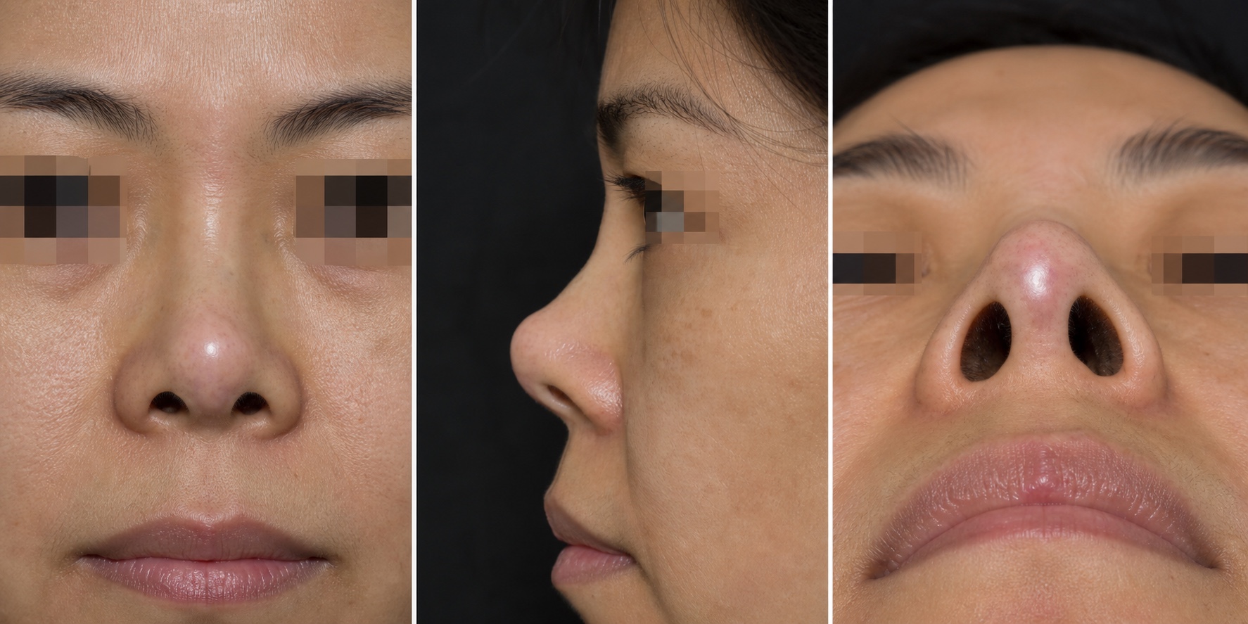 ภาพจำลอง AI แสดงผิวปลายจมูกบางจากแรงกดของวัสดุ