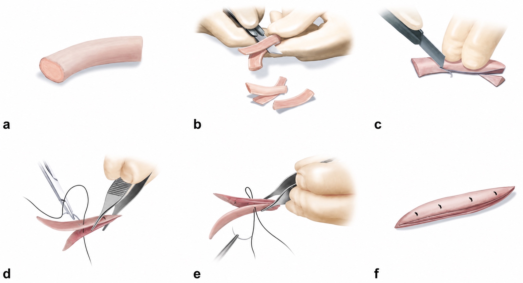 ภาพจำลอง แสดงลำดับการตัดแต่งและขึ้นรูป rib cartilage graft