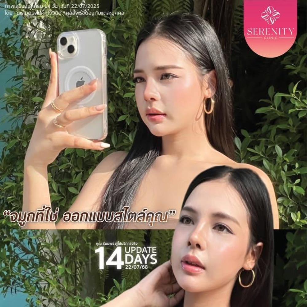 รีวิวเสริมจมูกทรงธรรมชาติ อัปเดต 14 วันหลังทำ