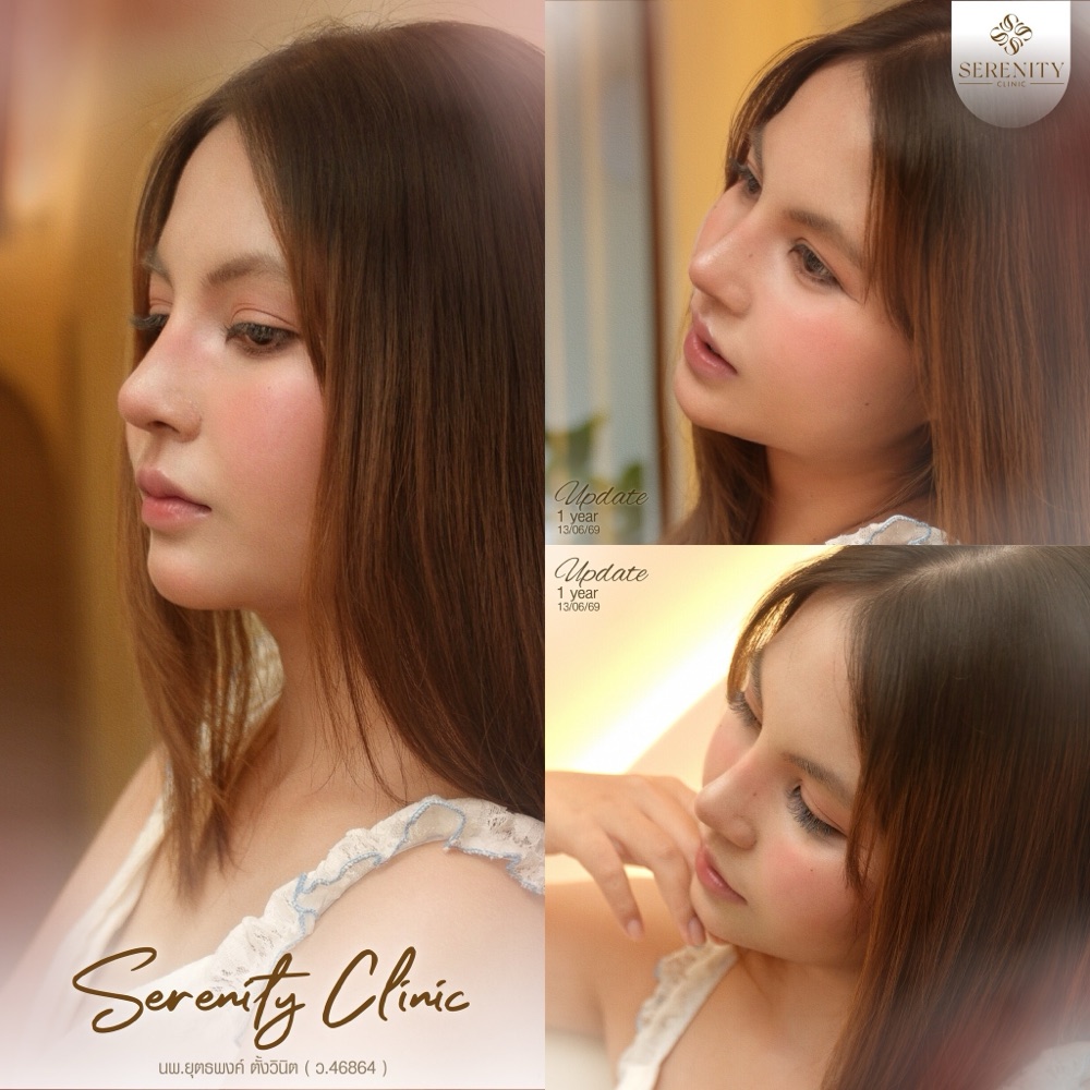 ภาพรีวิวจากผู้ใช้บริการเสริมจมูกของคลินิก