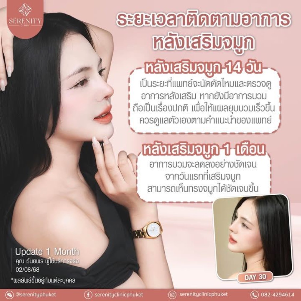 ระยะเวลาติดตามอาการหลังเสริมจมูก พร้อมภาพอัปเดต 14 วันและ 1 เดือน
