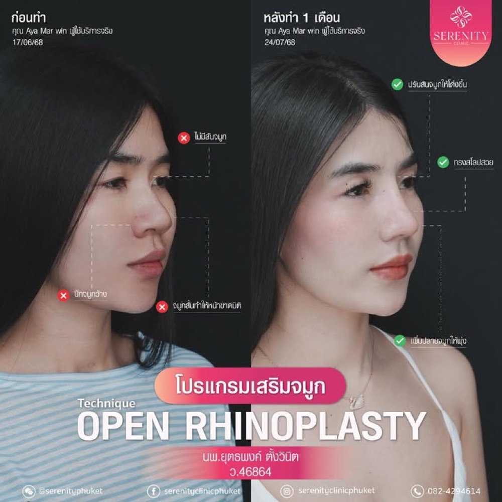 ภาพก่อนทำและหลังทำ 1 เดือน โปรแกรมเสริมจมูกเทคนิคโอเพ่น