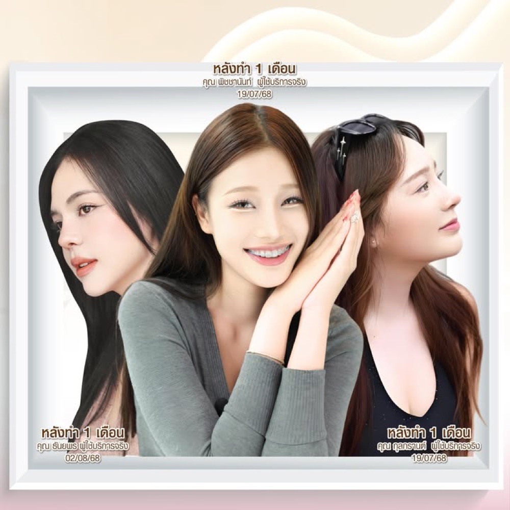 ภาพรีวิวหลังเสริมจมูก 1 เดือน