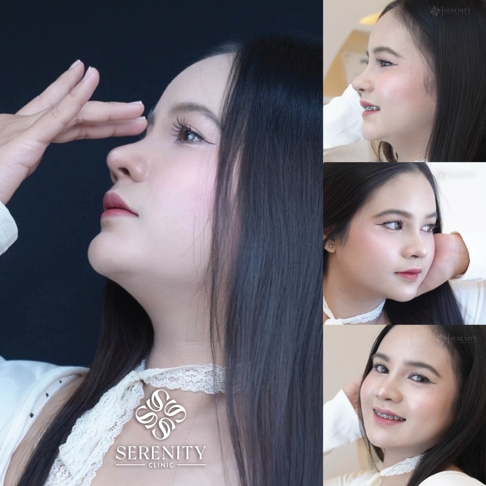 ภาพรีวิวเสริมจมูกหลายมุมจากผู้ใช้บริการ