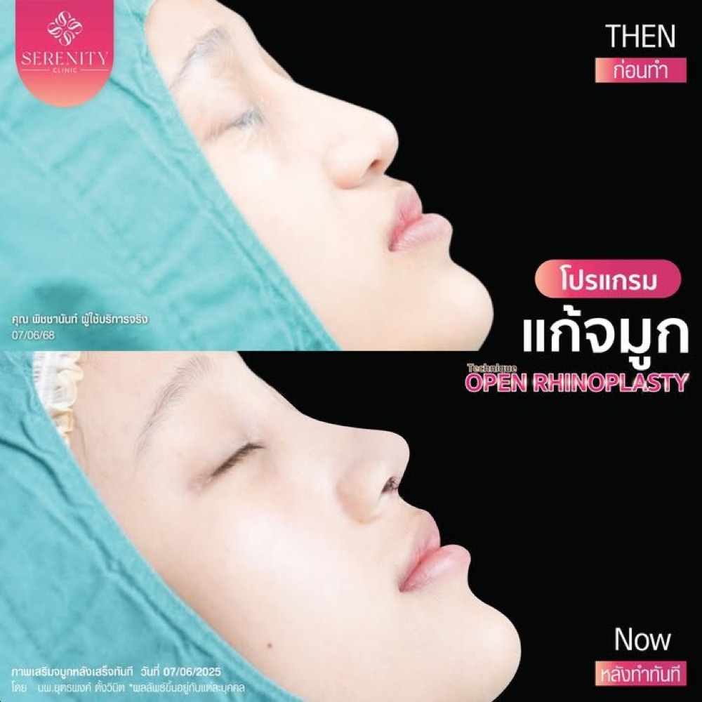 ภาพก่อนและหลังโปรแกรมแก้จมูกเทคนิคโอเพ่น