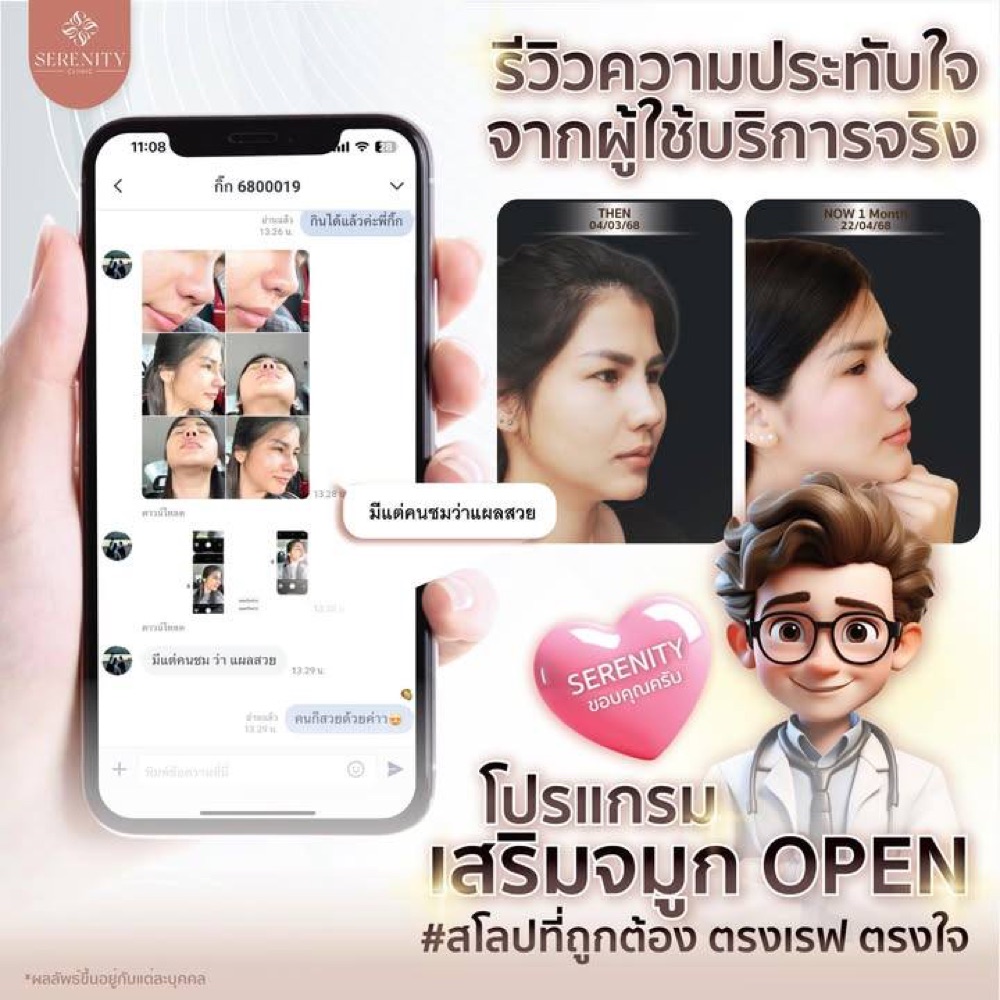 รีวิวความประทับใจจากผู้ใช้บริการเสริมจมูก พร้อมภาพก่อนและหลังทำ 1 เดือน
